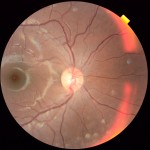 OCT optic nerve
